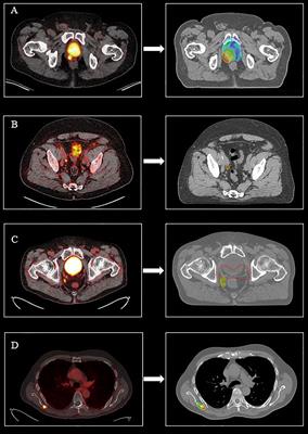 PET/CT-Based Salvage Radiotherapy for Recurrent Prostate Cancer After Radical Prostatectomy: Impact on Treatment Management and Future Directions